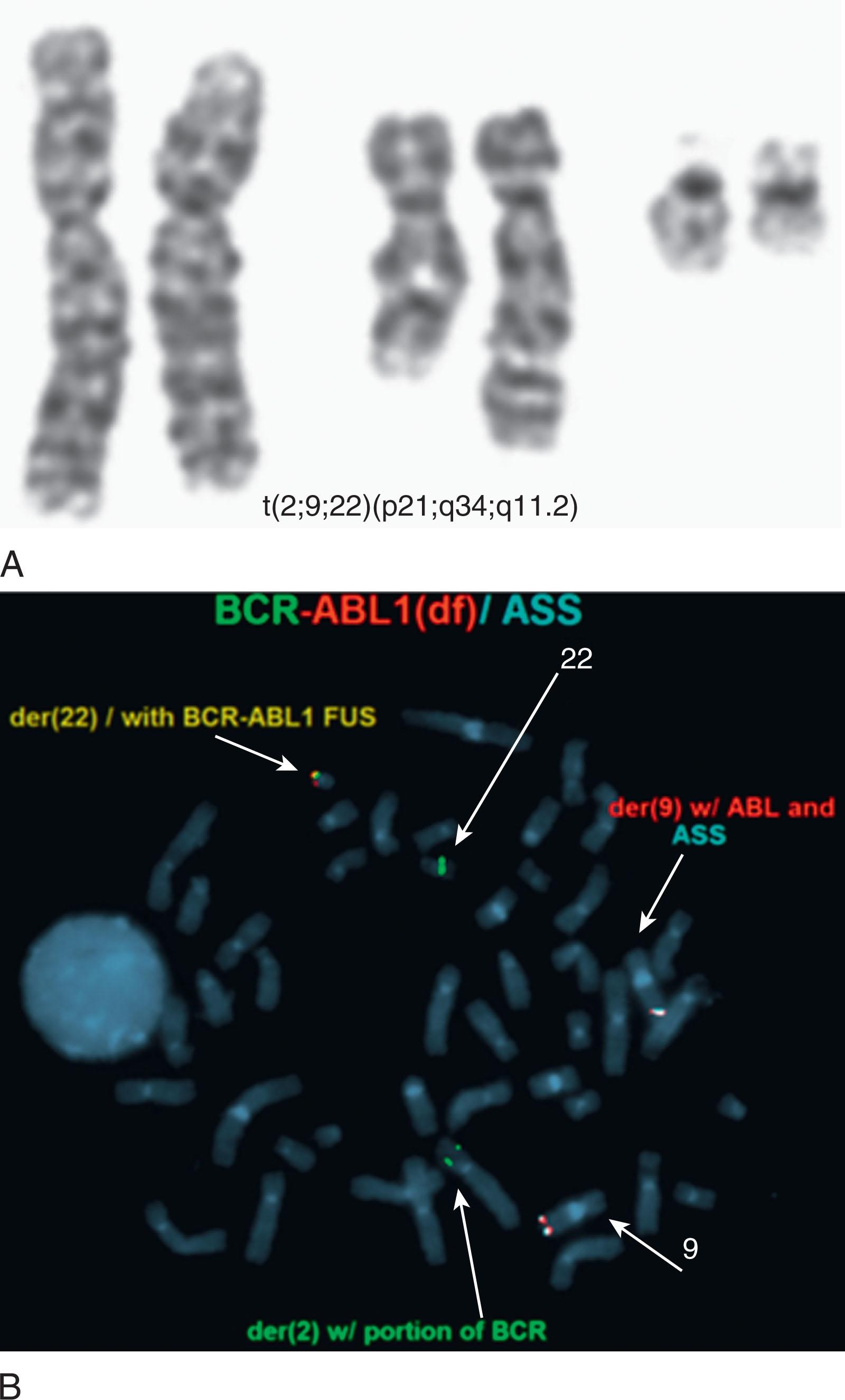 Figure 57.10, (A) Complex Ph translocation. Top: A partial karyotype from a patient showing a three-way translocation t(2;9;22) and (B) metaphase FISH (bottom) indicating that even in complex karyotype the fusion of BCR and ABL1 takes place on the Ph chromosome or der(22) indicated in yellow .