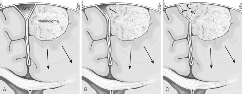 Figure 10.1, Classification of parasagittal meningiomas according to the relationship with the superior sagittal sinus. (A) Type I parasagittal meningioma (B) Type II parasagittal meningioma (C) Type III parasagittal meningioma.