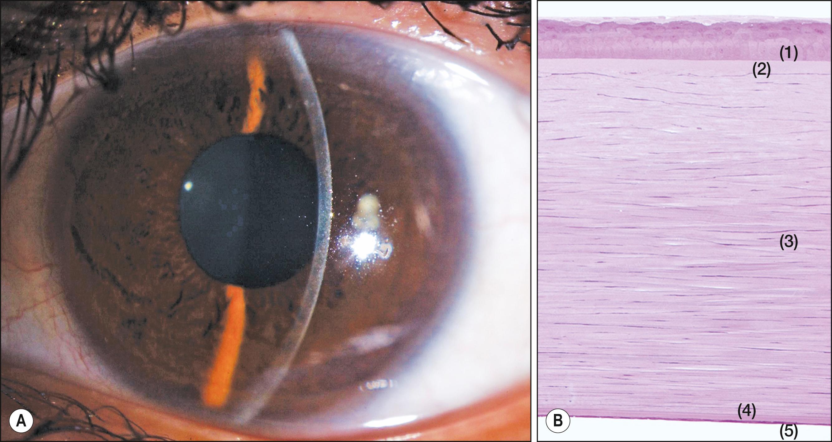 Fig. 1.1, Anatomy of the human cornea. ( A ) Slit lamp microscopic view of the cornea. ( B ) Histology of the cornea showing the epithelium (1) , Bowman layer (2) , stroma (3) , Descemet membrane (4) , and endothelium (5) .