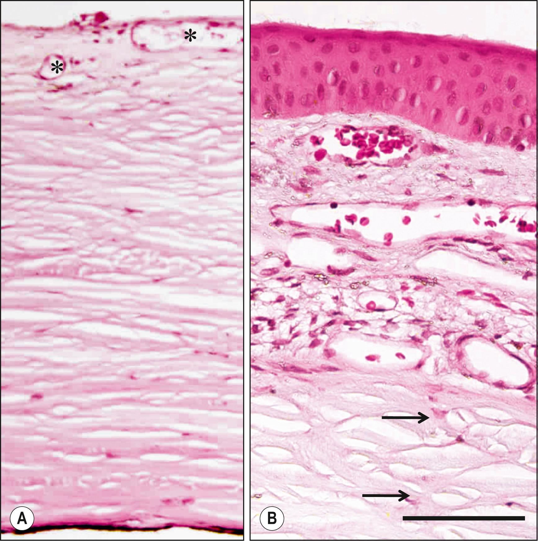 Fig. 1.2, Histology of the human sclera. ( A ) Hematoxylin and eosin staining of a cross-section of the sclera. Blood vessels (asterisks) are largely restricted to the episclera (upper region of section) . ( B ) Higher-magnification view of the conjunctiva and episclera as well as of stromal fibroblasts (arrows) in the sclera. Bar: 100 μm.