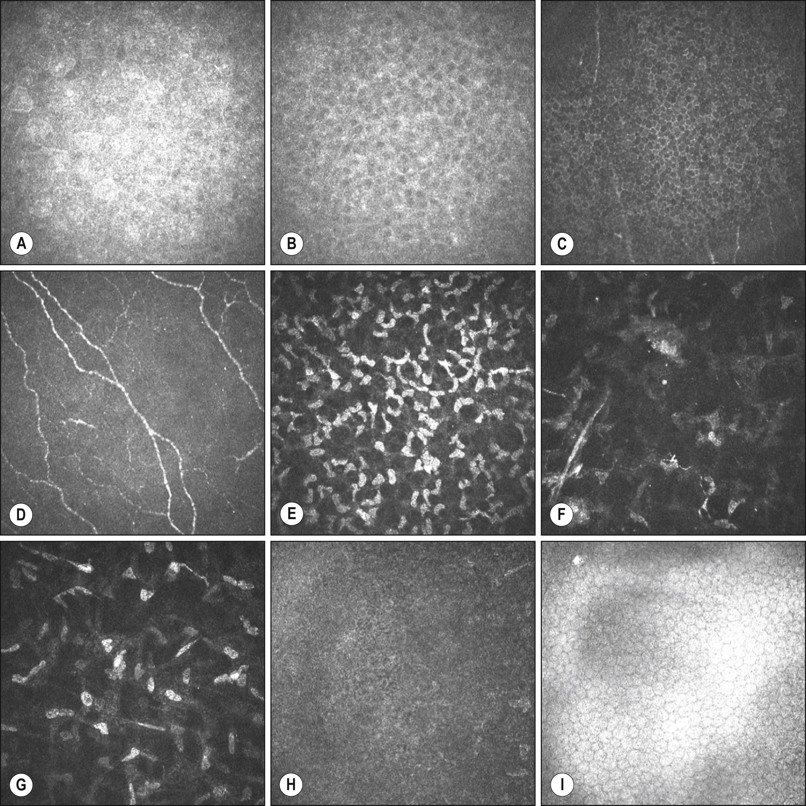 Fig. 1.3, Confocal biomicroscopy of the human cornea. ( A–C ) Superficial, wing, and basal cell layers of the corneal epithelium, respectively. ( D ) Subepithelial nerve plexus. ( E ) Shallow layer of the stroma, containing a high density of polygonal keratocytes. ( F ) Midlayer of the stroma, containing thick, nonbranching nerve fibers. ( G ) Deep layer of the stroma, containing a lower density of keratocytes. ( H ) Amorphous appearance of Descemet membrane. ( I ) Endothelium, comprising hexagonal endothelial cells of uniform size.