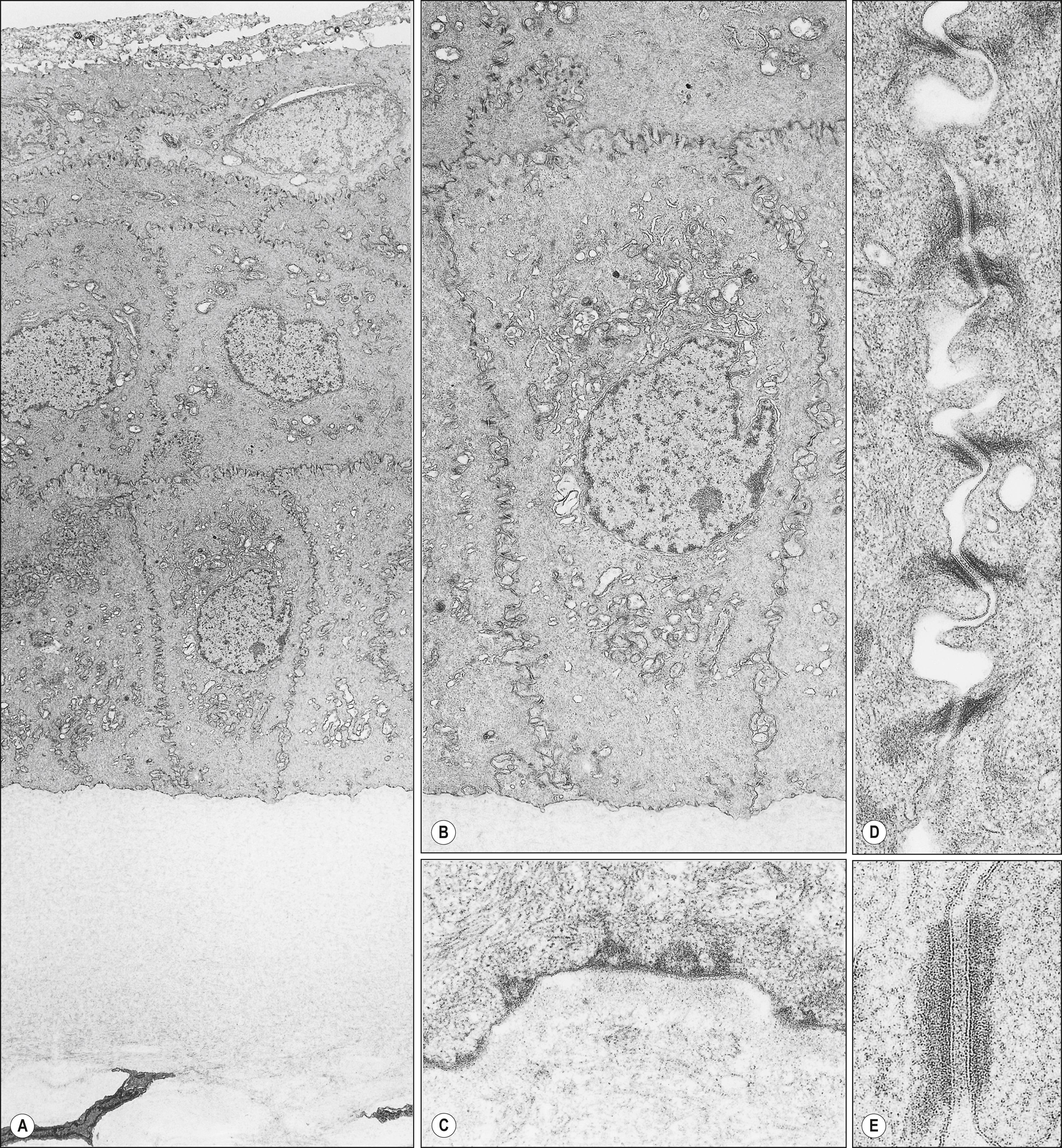 Fig. 1.4, Transmission electron microscopy of the human corneal epithelium. ( A ) The epithelium comprises five or six layers of epithelial cells. The electron-dense cell is about to undergo desquamation. ( B ) Basal cells. Note the numerous junctional complexes. ( C ) Basement membrane and anterior portion of Bowman layer. Note hemidesmosomes at the basal surface of the epithelial cells. ( D ) Interdigitation and junctional complexes at the lateral surface of basal epithelial cells. ( E ) Gap junction at the lateral surface of basal cells.