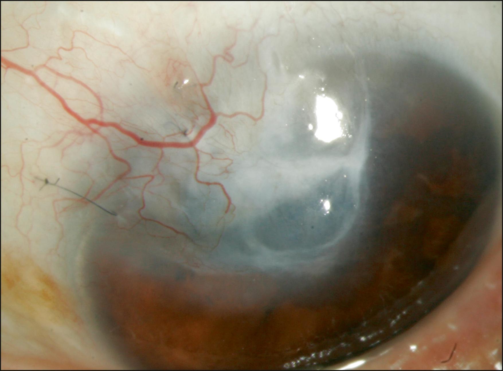 Fig. 96.1, Corneal scar and neovascularization after phacoemulsification burn at the clear corneal incision.