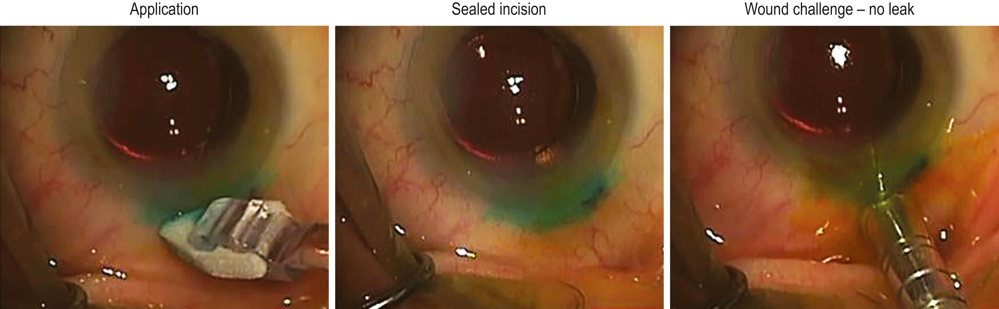 Fig. 96.3, Clear corneal incision closed with adhesive bandage.