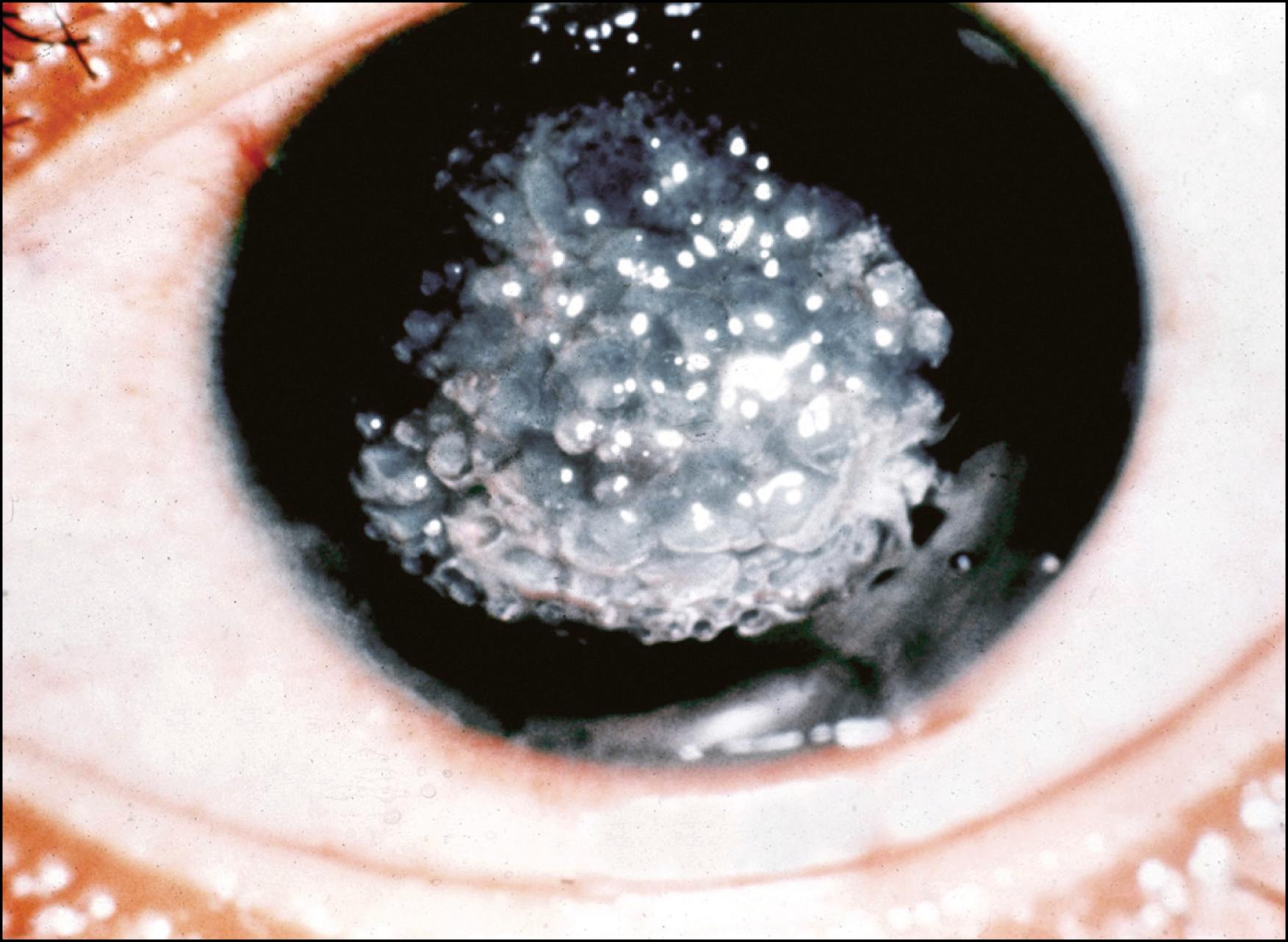 Fig. 22.12, Gelatinous drop-like dystrophy.