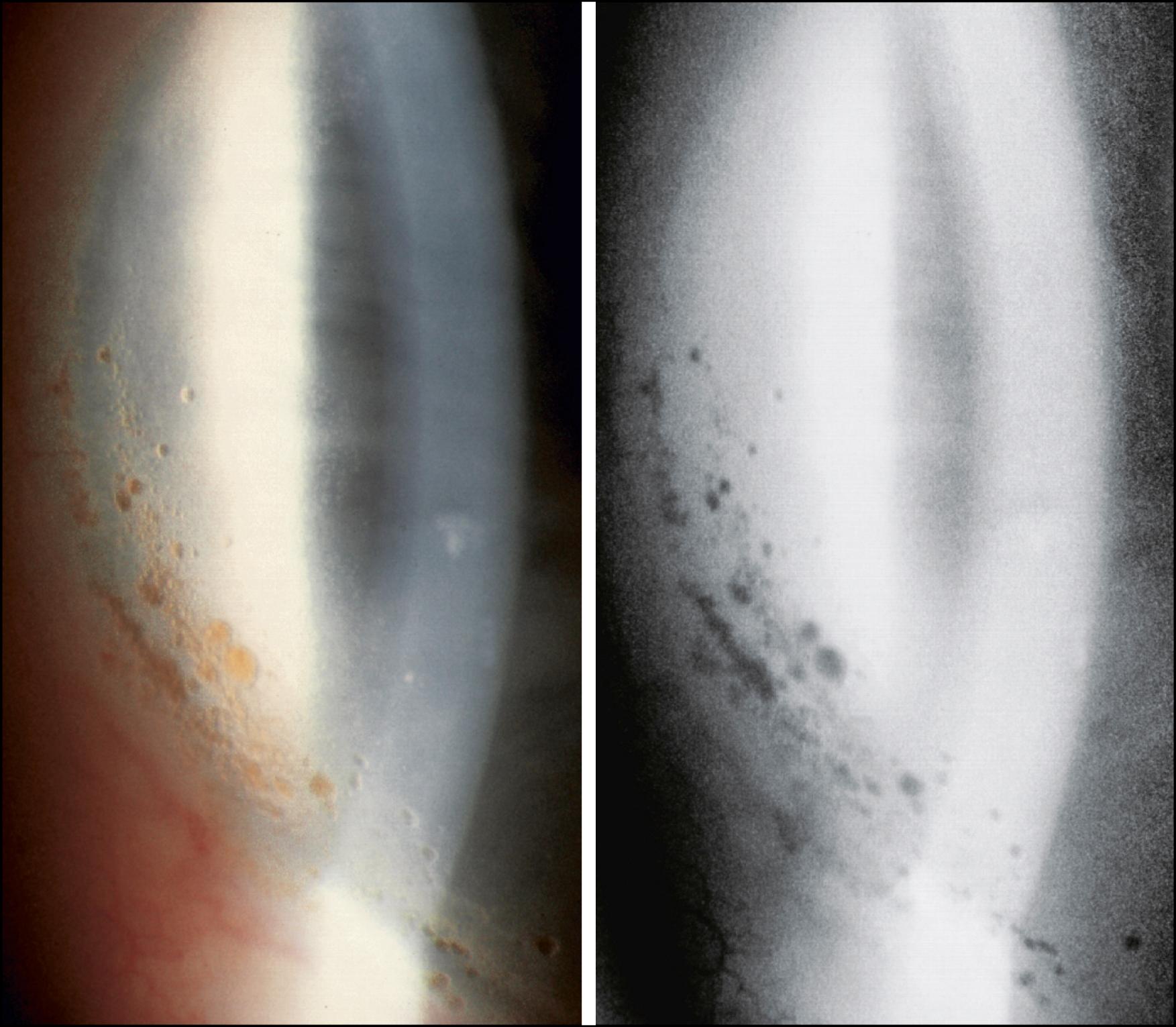 Fig. 22.4, Spheroidal degeneration and intraepithelial ointment.