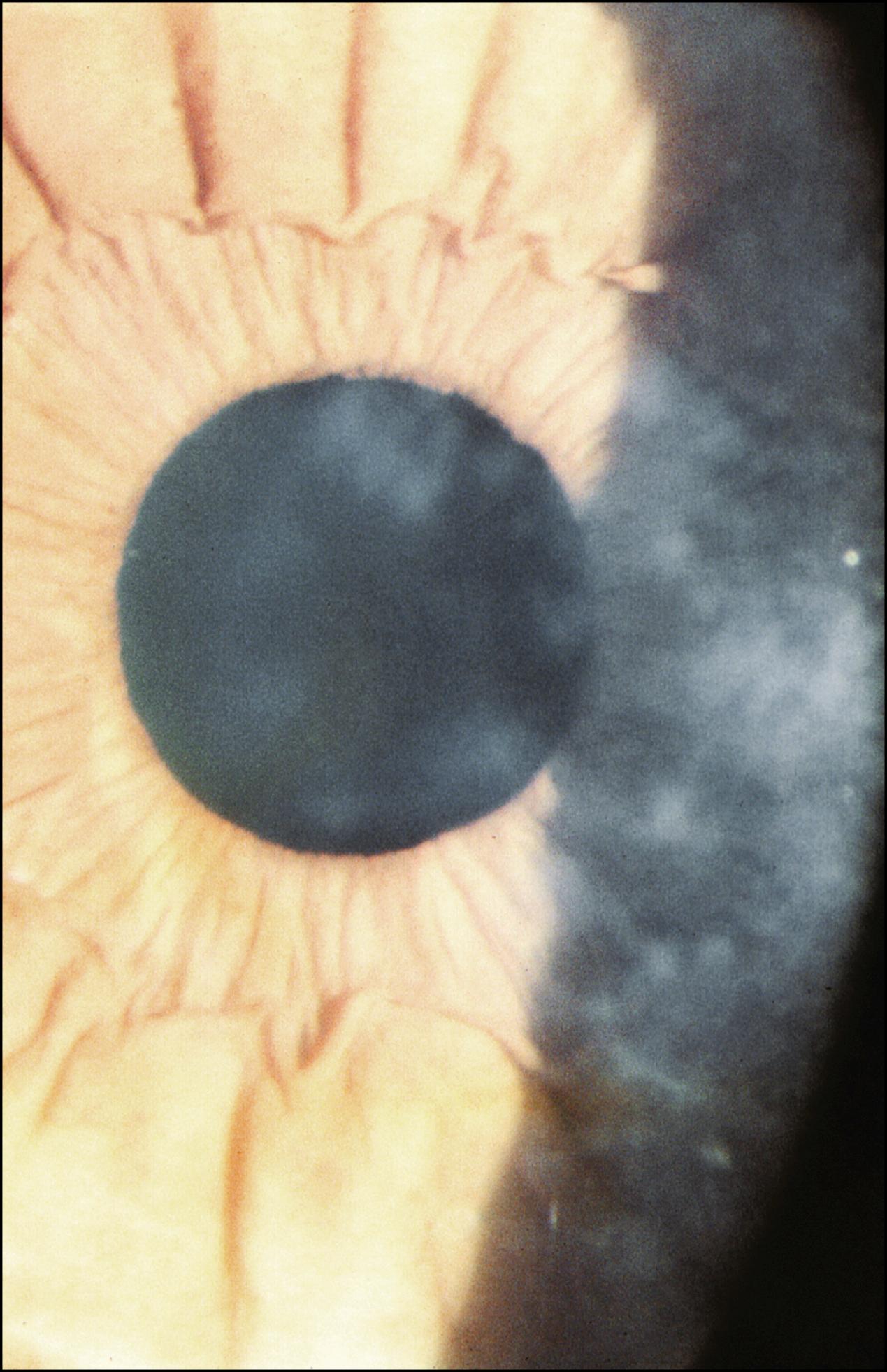 Fig. 22.6, Subepithelial mucinous dystrophy.