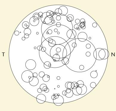 Fig. 26.7, Cartogram showing the size and location of infiltrates for all wearing modalities and lens types. The large outer circle represents a 12-mm-diameter cornea. Data from left eyes have been horizontally mirror transposed so that all infiltrates are represented as if for the right eye only. N, nasal; T, temporal.