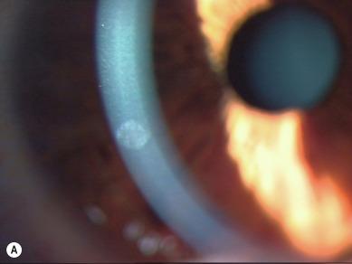 Fig. 26.9, Appearance of the so-called contact lens peripheral ulcer (CLPU). (A) Residual scar from a CLPU. (B) ‘Bull’s eye’ appearance of a CLPU scar viewed at high magnification.