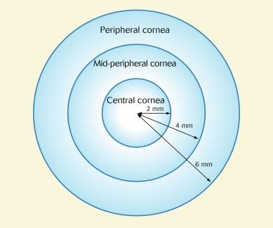 Fig. 26.11, Schematic representation of the central, mid-peripheral and peripheral zones of the cornea. The mid-peripheral and peripheral zones represent 89% of the corneal surface.