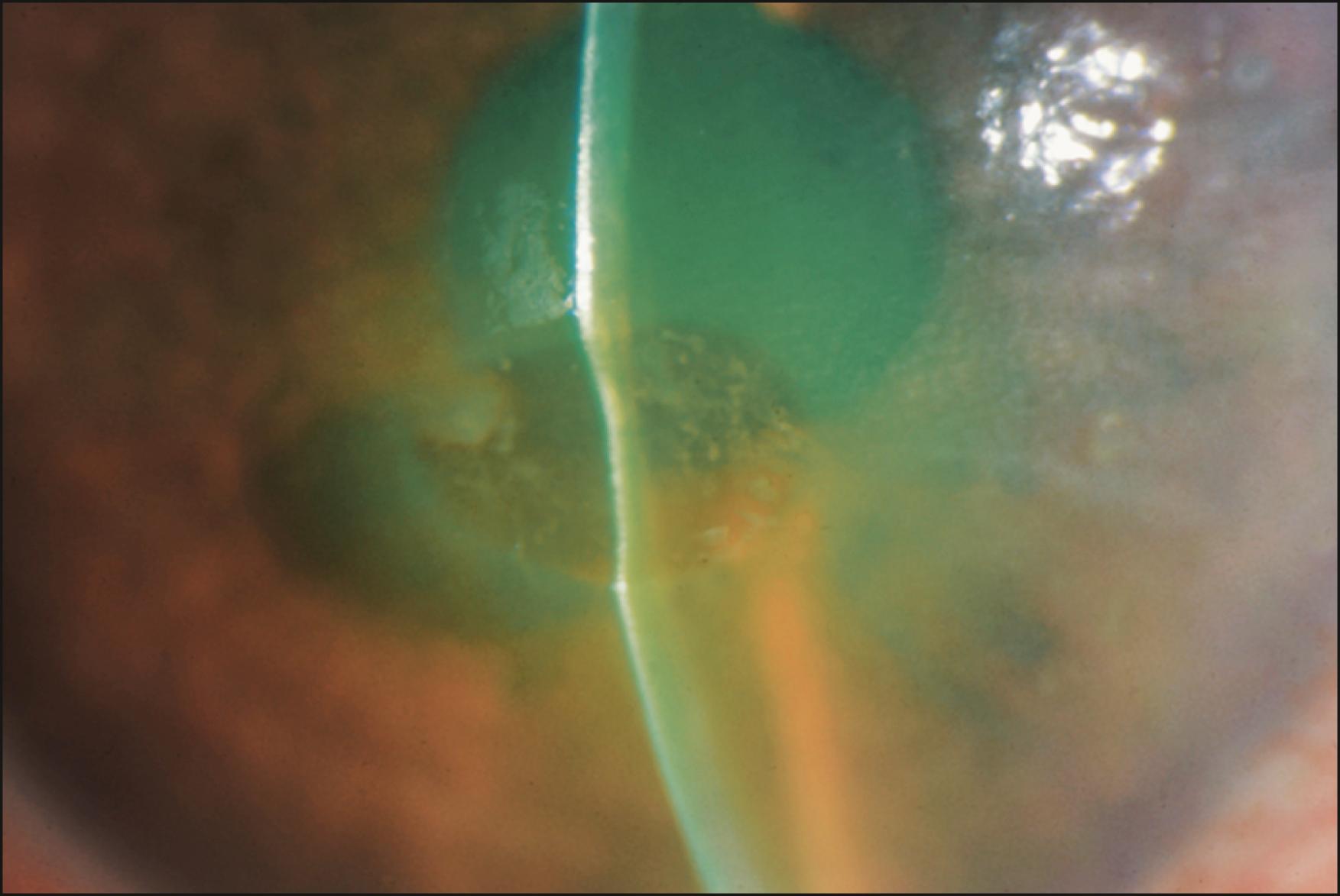 Fig. 68.3, Corneal melt after NSAID use.