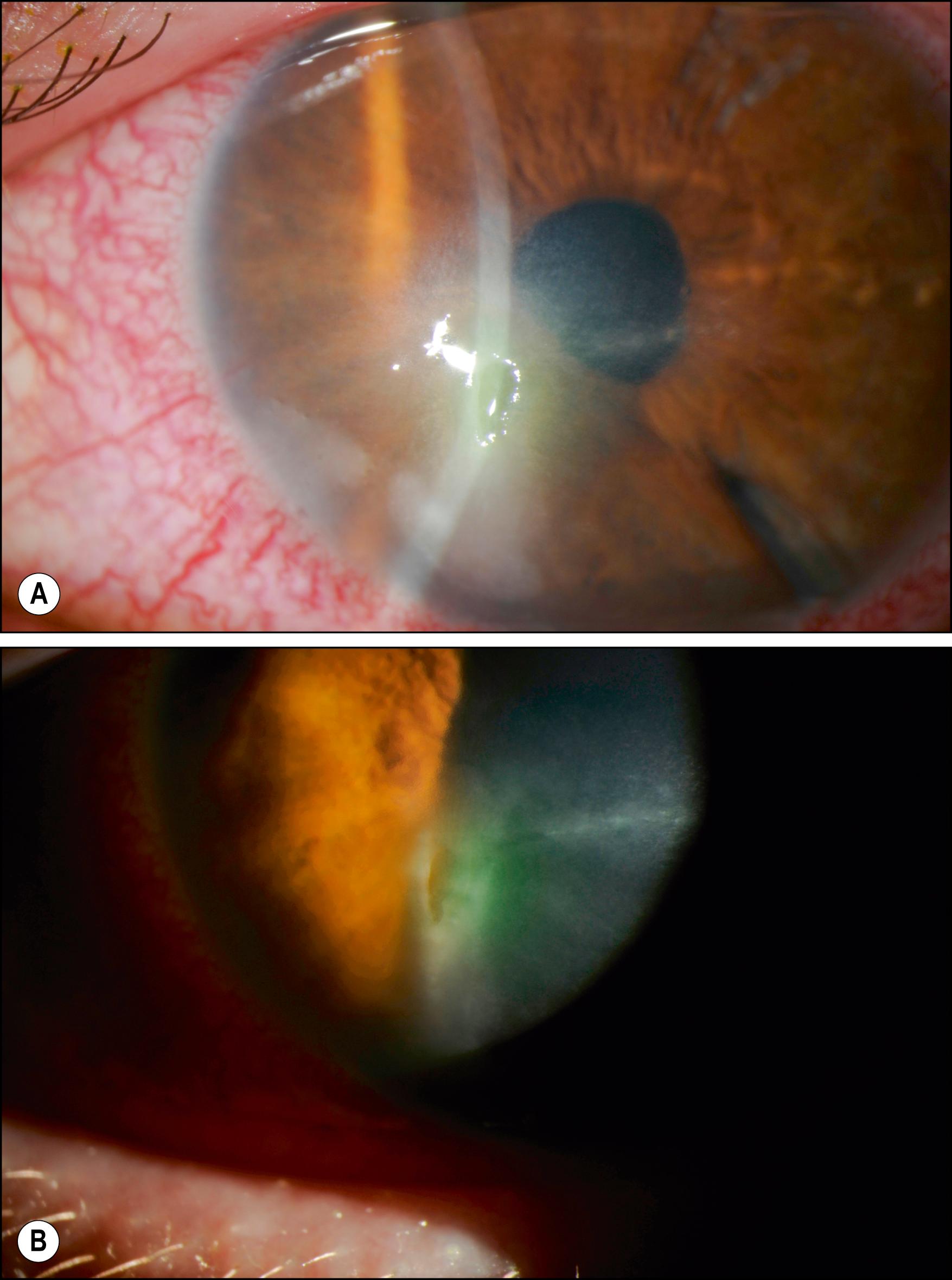 Fig. 58.1, ( A ) Slit lamp photograph of a 31-year-old type I diabetic with diabetic keratopathy. Note the persistent epithelial defect, stromal haze, and corneal thinning. (Courtesy Pankaj Gupta, MD.) ( B ) Higher magnification view of the persistent epithelial defect with surrounding stromal haze.