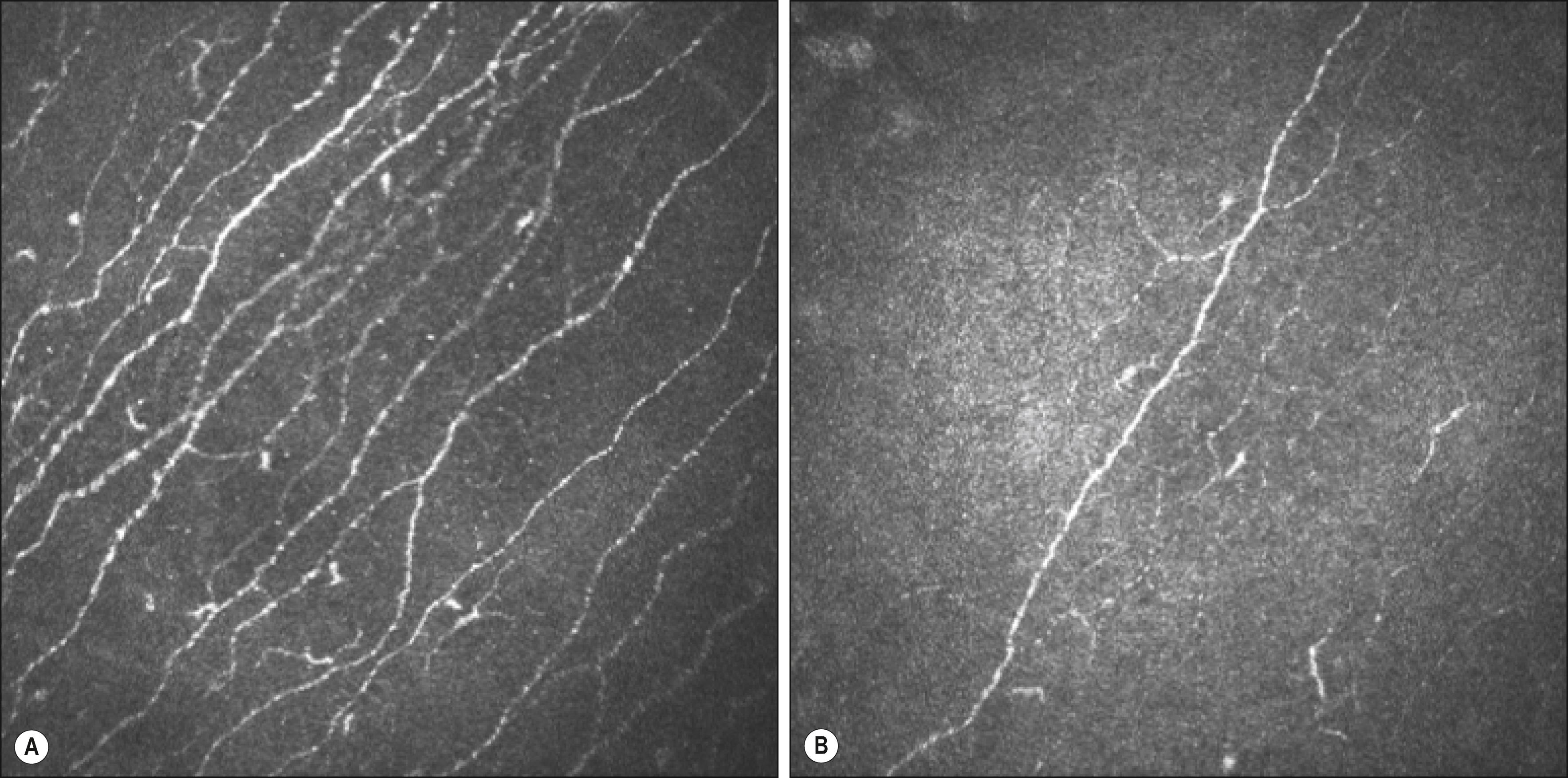 Fig. 58.2, ( A ) Confocal microscopy images of corneal nerves in the Bowman layer from a healthy subject. ( B ) Confocal microscopy images of the corneal nerves in the Bowman layer from a diabetic patient with severe neuropathy. Note the marked reduction in the density of the corneal nerves.