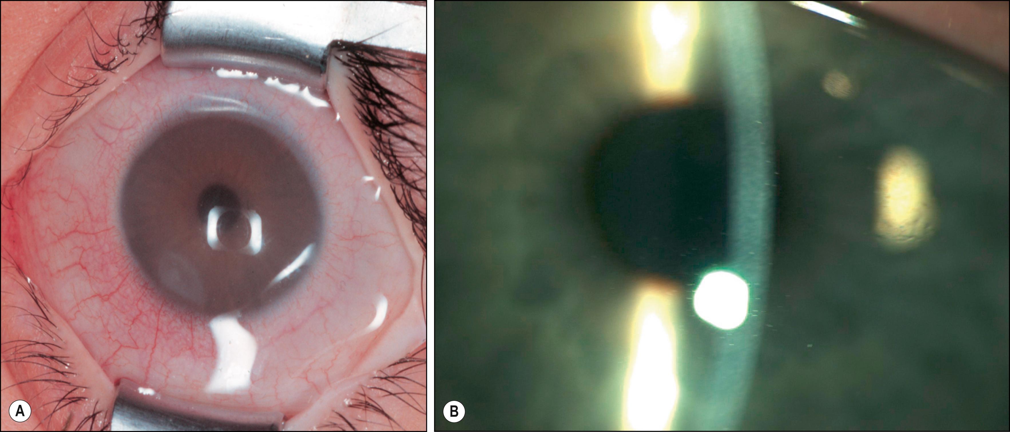 Fig. 58.4, ( A ) Intraoperative picture showing a cloudy cornea in a 7-year-old boy with Hurler syndrome. (Courtesy Peter Meyer, MD.) ( B ) Slit lamp photograph of a 14-year-old girl with Hurler syndrome. Note the marked stromal clouding within the slit beam.