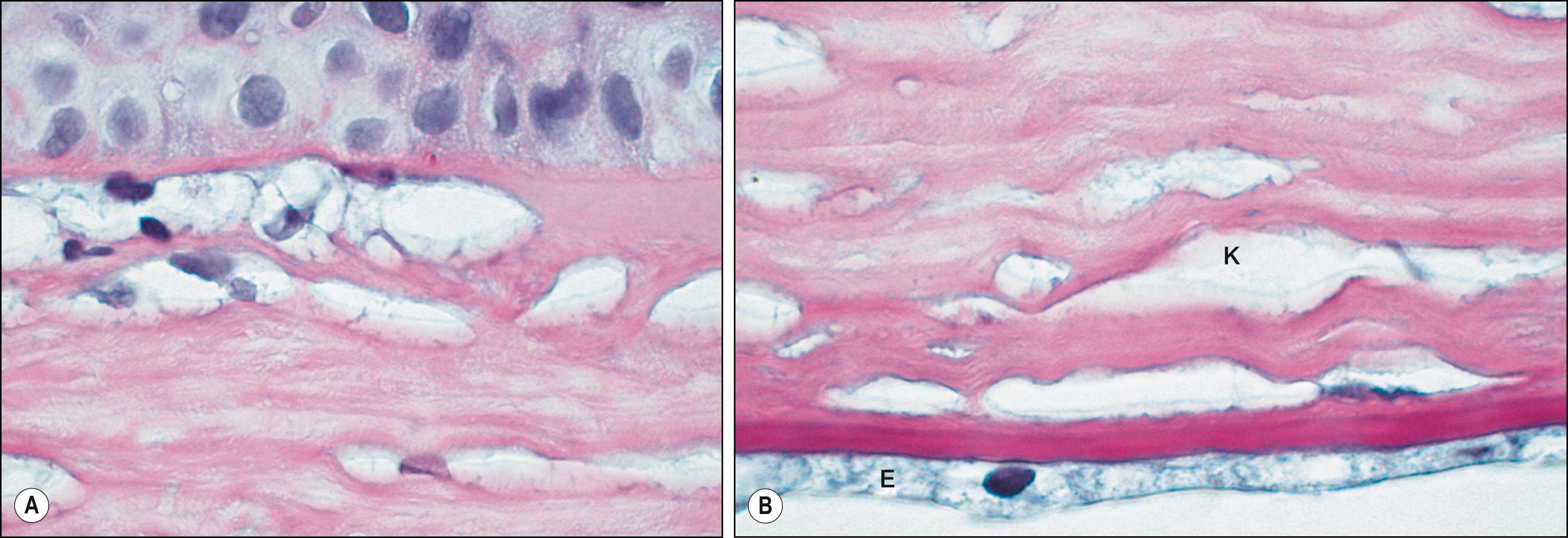 Fig. 58.5, ( A ) Anterior cornea from a case of Hurler syndrome (PAS, magnification ×400). (Courtesy Peter Meyer, MD.) ( B ) Posterior corneal stroma in Hurler syndrome showing granular deposits within keratocytes (K) and the endothelium (E) (PAS, magnification ×400).