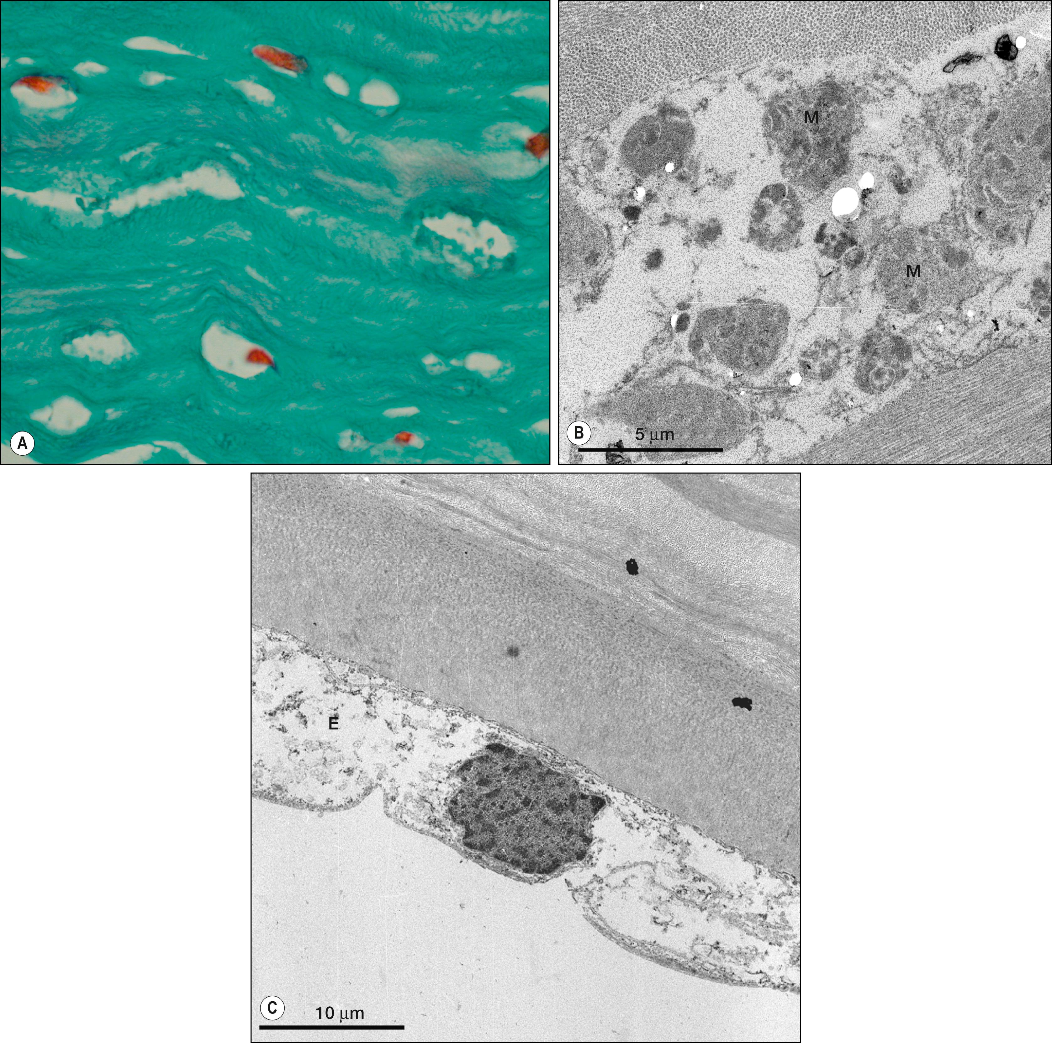 Fig. 58.6, ( A ) Mid corneal stroma in case of Hurler syndrome showing granular deposits within keratocytes (Masson, magnification ×400). (Courtesy Peter Meyer, MD.) ( B ) Transmission electron microscopy showing keratocyte in Hurler syndrome containing cytoplasmic deposits of mucopolysaccharide (M) . (Courtesy Peter Meyer, MD.) ( C ) Transmission electron microscopy of endothelial cells (E) with granular cytoplasm in Hurler syndrome.