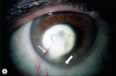 Fig. 25.2, Deep stromal neovascularization. (A) A large feeding vessel (arteriole with accompanying venule) extending from the limbus towards a dense central corneal scar in a contact lens wearer (thin arrow). Superficial neovascularization is also evident in the inferior cornea (thick arrow). (B) Branching vessels in the deep stroma of a patient who has been refitted with rigid lenses.