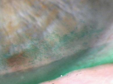 Fig. 18.3, Diffuse lissamine green staining of the inferior cornea.