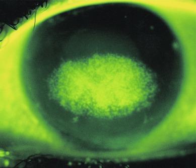 Fig. 18.5, Coalescent superficial corneal staining.