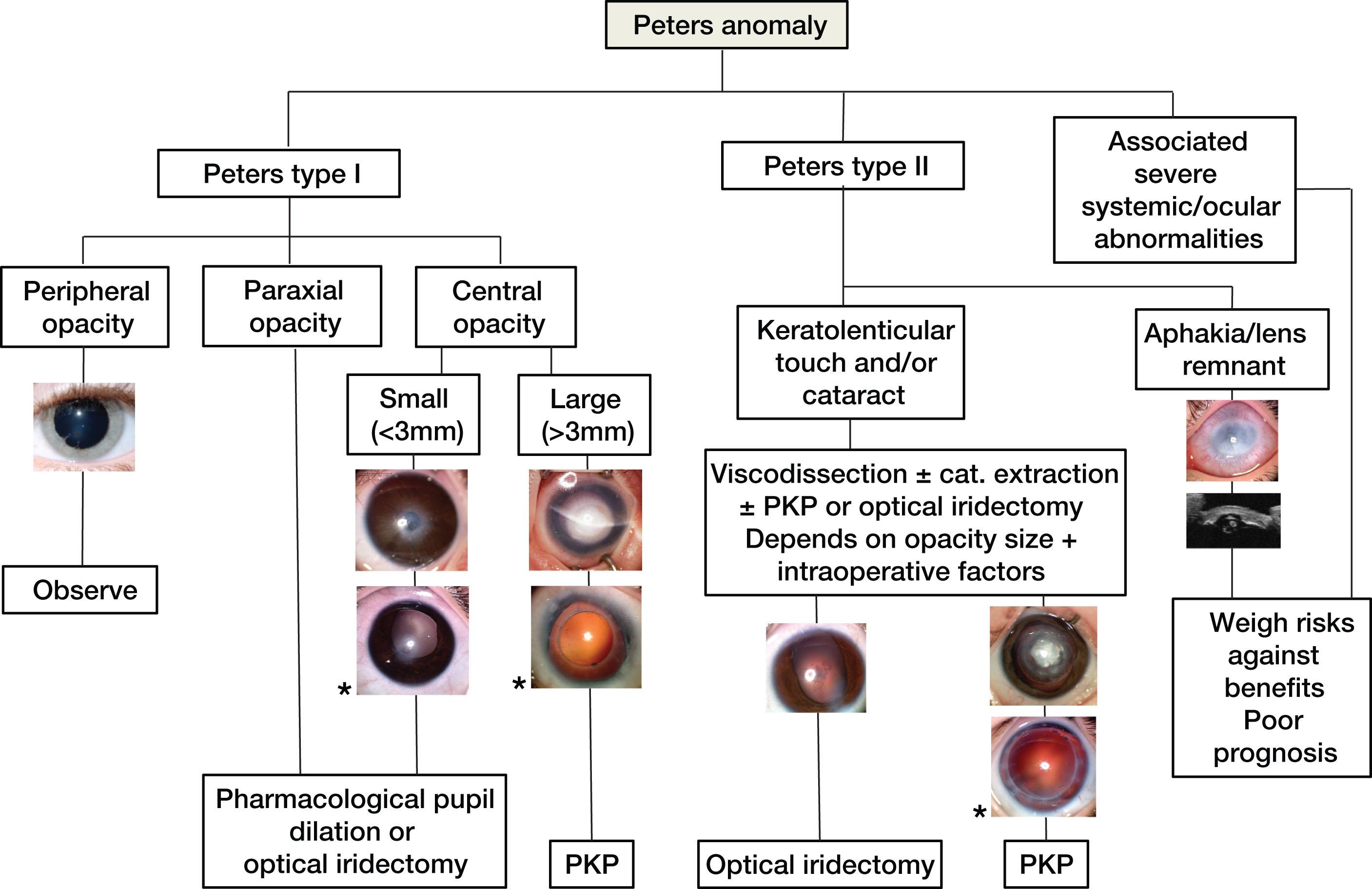 Fig. 33.1, Flow chart showing suggested management algorithm for Peters anomaly. Asterisk denotes postoperative photograph of the patient above. PKP, penetrating keratoplasty.