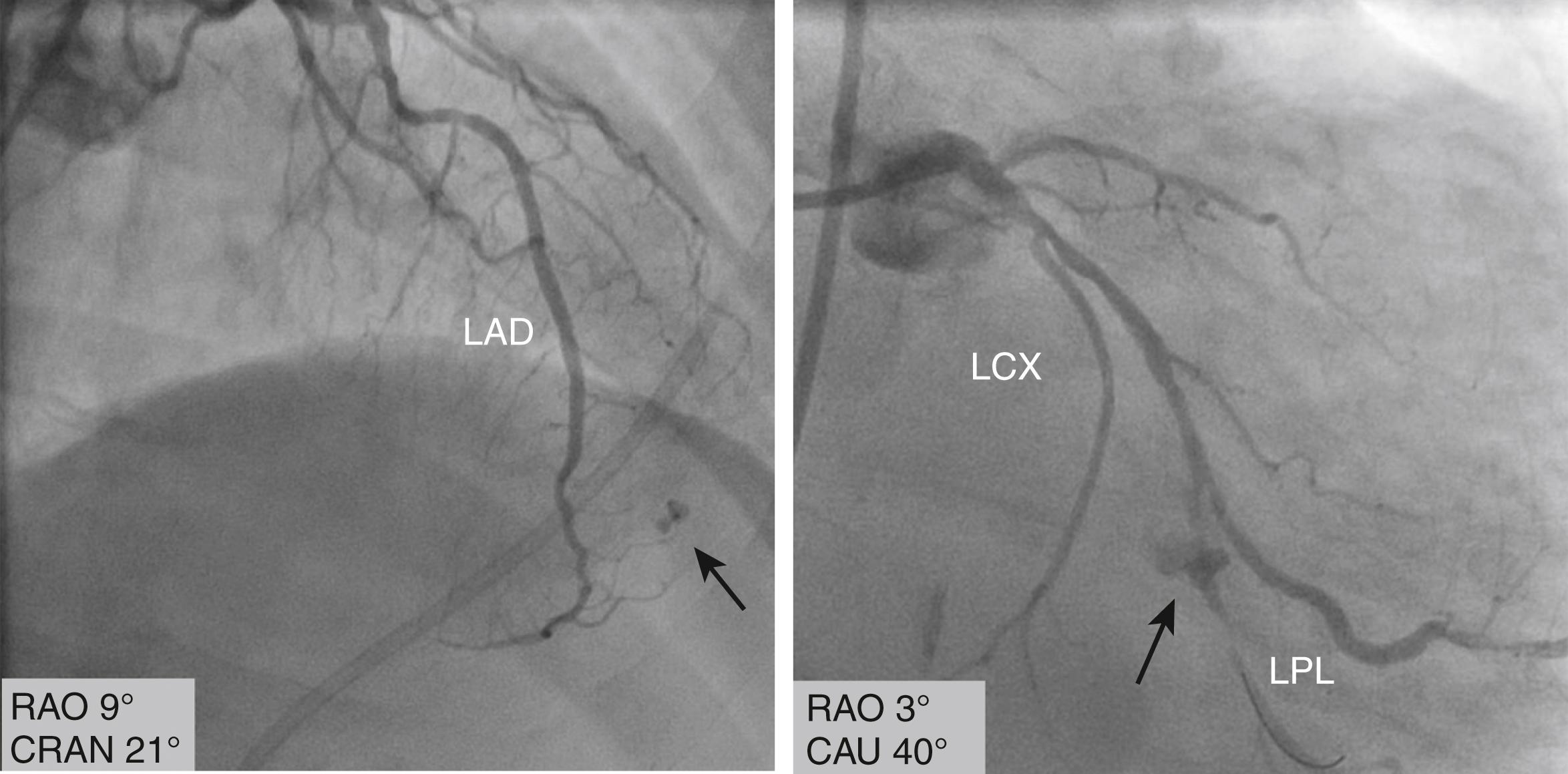 FIGURE 21.1, Iatrogenic coronary perforations.