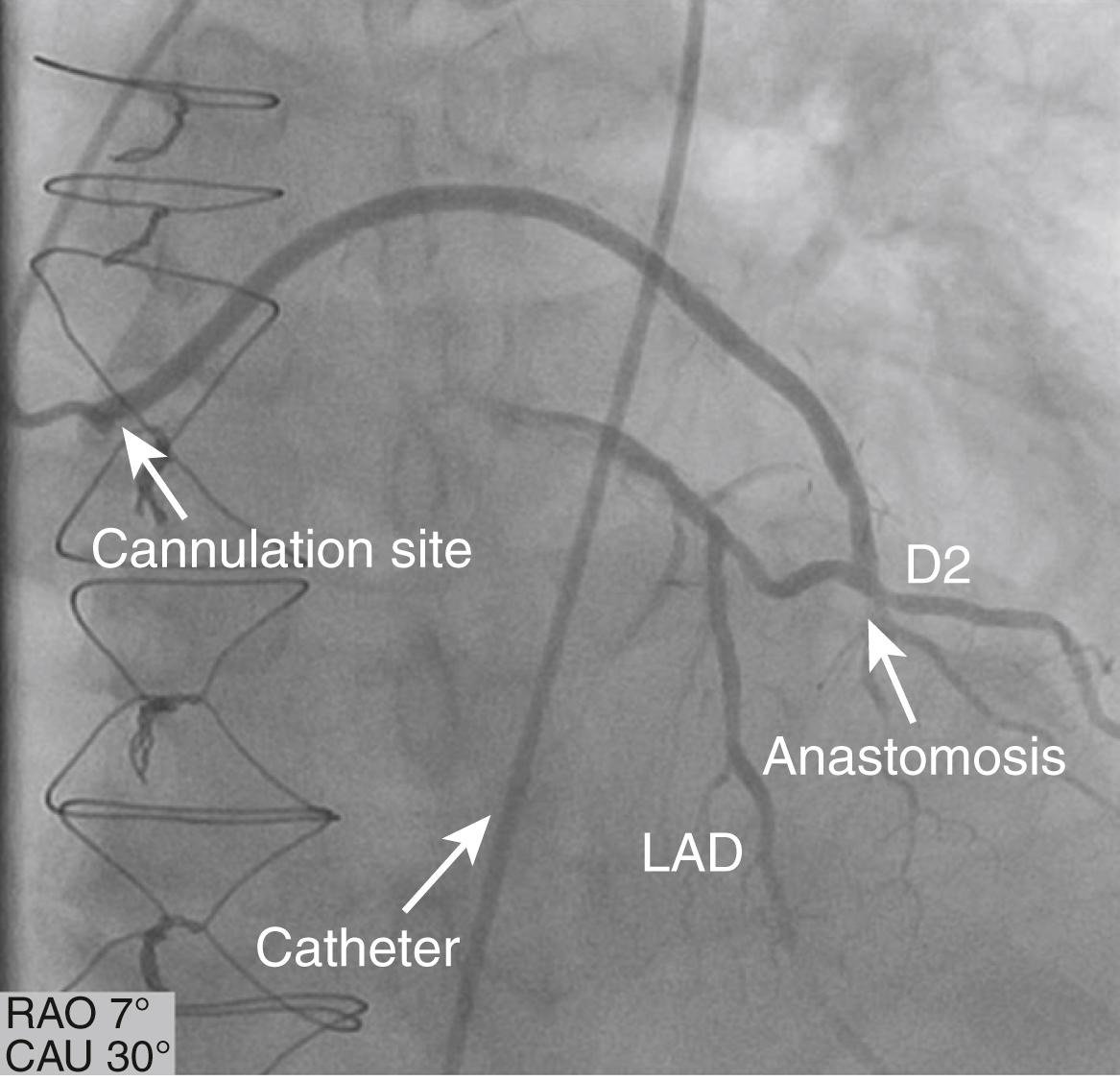 EFIGURE 21.5, Free radial graft to large diagonal branch. CAU, Caudal; D2, second diagonal branch; LAD, left anterior descending artery; RAO, right anterior oblique.