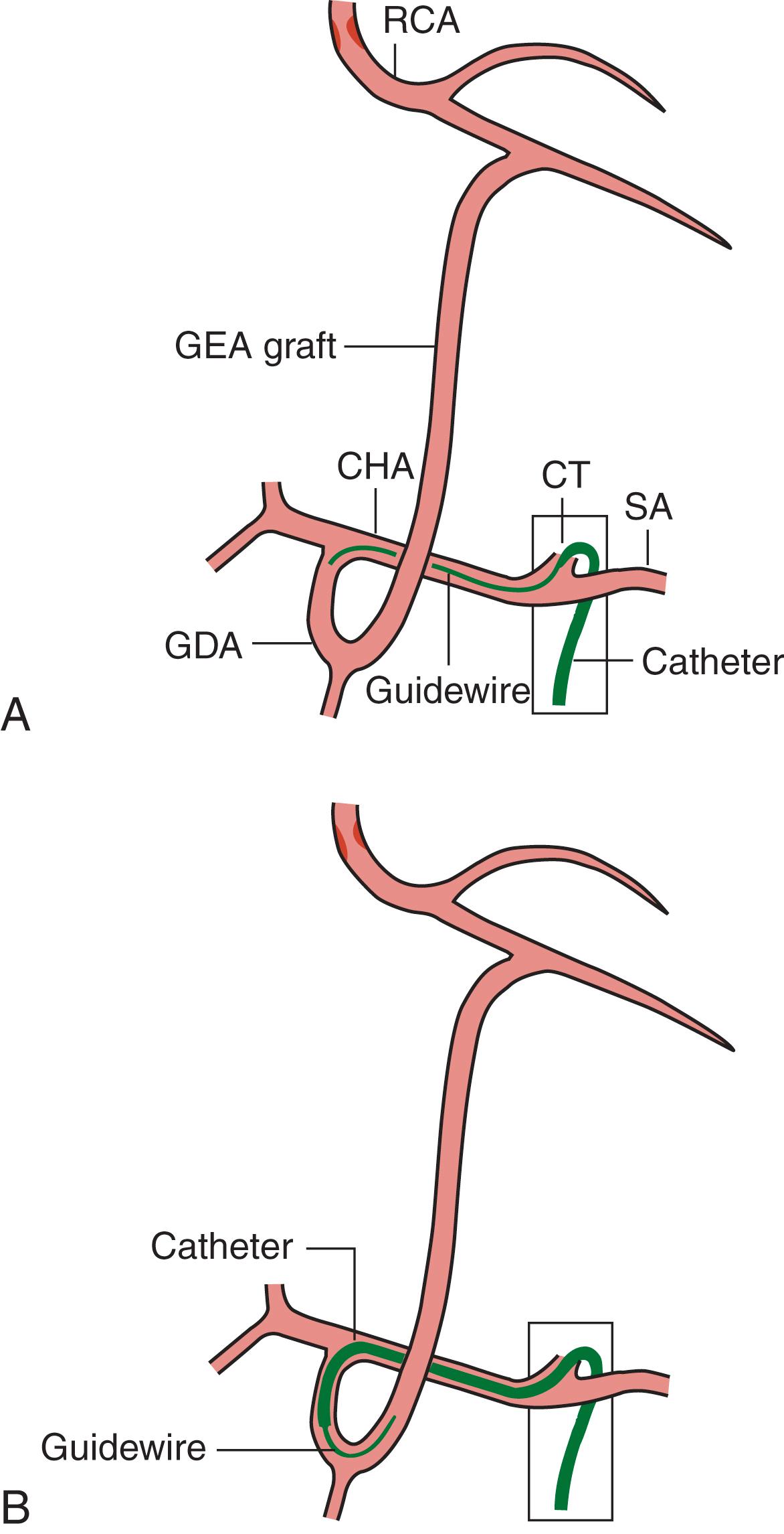 FIGURE 21.8, Catheterization of right gastroepiploic artery ( GEA ) graft.