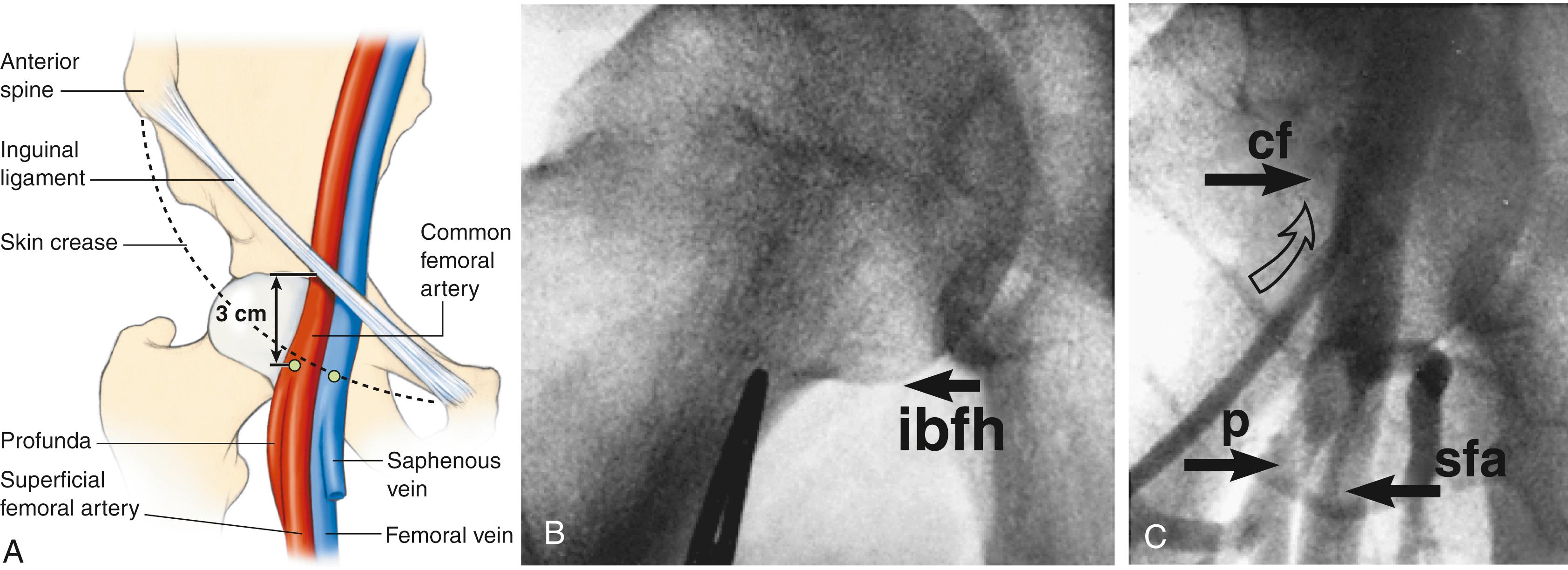 EFIGURE 21.1, (See eFig. 41.4 for the use of ultrasound guidance for femoral access.) A, Diagram of femoral artery and vein anatomy. The arterial skin nick should be placed approximately 3 cm below the inguinal ligament and directly over the femoral arterial pulsation; the venous skin nick should be placed at the same or lower level but approximately one fingerbreadth more medially. B, Localization of the skin nick by fluoroscopy and use of a hemostat, the top of which should point to the inferior border of the femoral head ( ibfh ). C, Catheter insertion ( open arrow ) into the common femoral artery ( cf ), above the bifurcation into the superficial femoral artery ( sfa ) and profunda ( p ) branches.