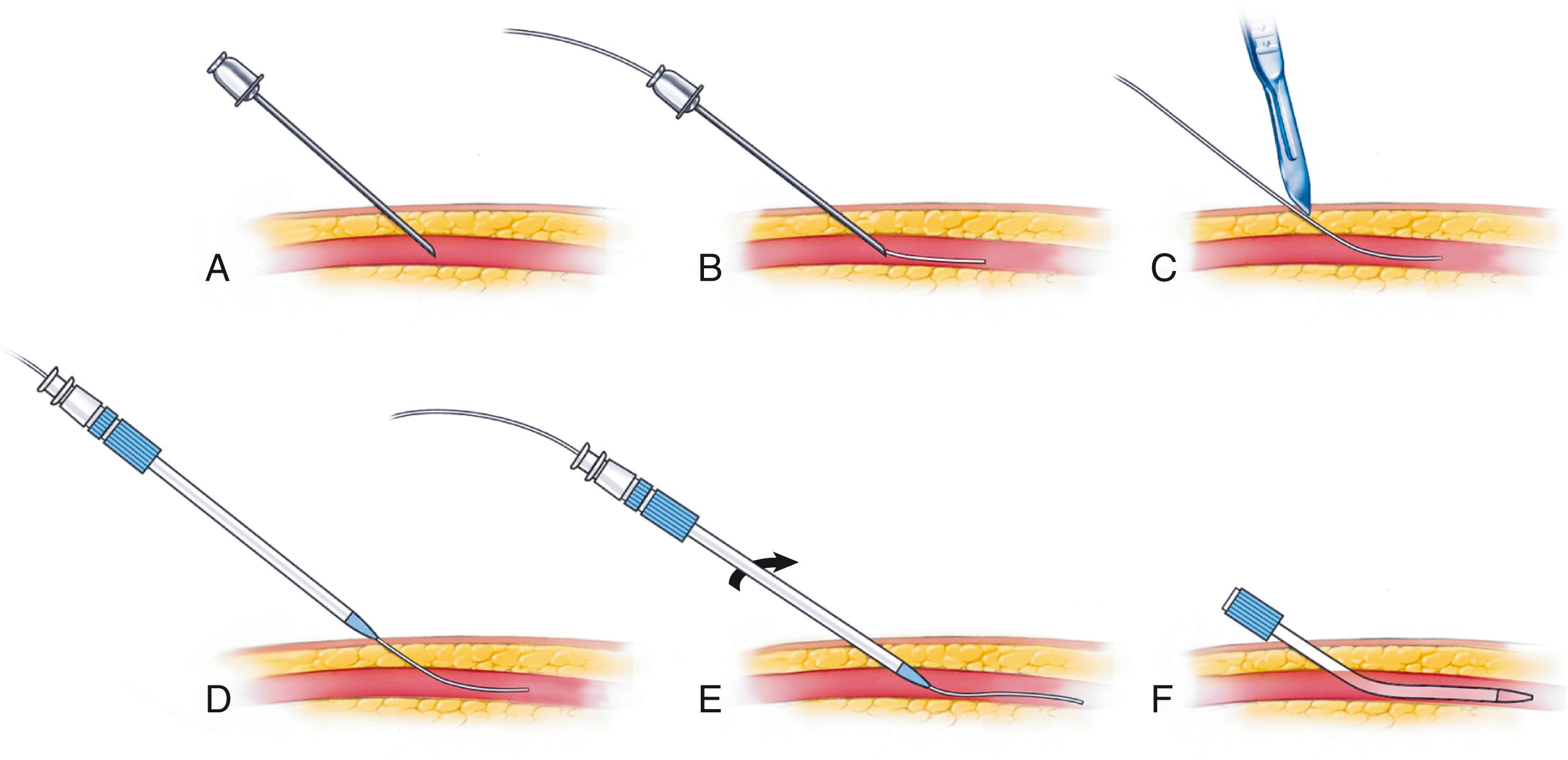 EFIGURE 21.2, Modified Seldinger technique for percutaneous introduction of the catheter sheath. A, Vessel punctured by the needle. B, Flexible guidewire placed into the vessel through the needle. C, Needle removed, guidewire left in place, and hole in skin around wire enlarged with a scalpel. D, Sheath and dilator placed over guidewire . E, Sheath and dilator advanced over guidewire and into the vessel. F, Dilator and guidewire removed while sheath remains in the vessel.