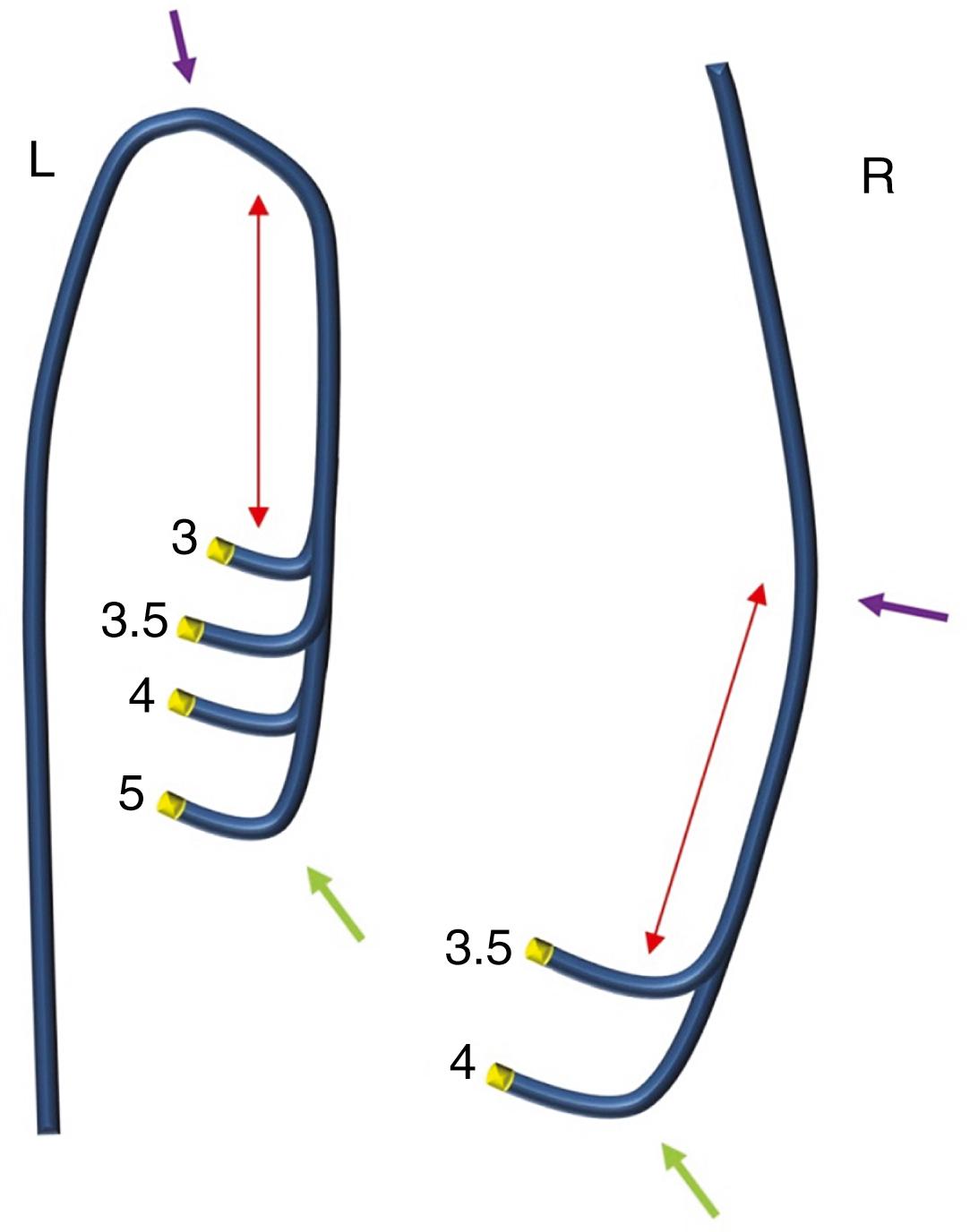 FIGURE 21.3, Judkins catheters.