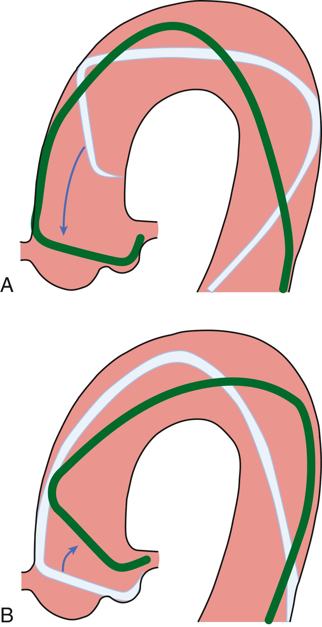 FIGURE 21.5, A, Push-pull technique for catheterization of the left coronary artery (LCA) with the Judkins left catheter. In the LAO view, the coronary catheter is positioned in the ascending aorta over a guidewire, and the guidewire is removed. The catheter is advanced so that the tip enters the left sinus of Valsalva. B, If the catheter does not selectively engage the ostium of the LCA, further slow advancement into the left sinus of Valsalva creates a temporary acute angle at the catheter. Prompt withdrawal of the catheter allows easy entry into the artery.