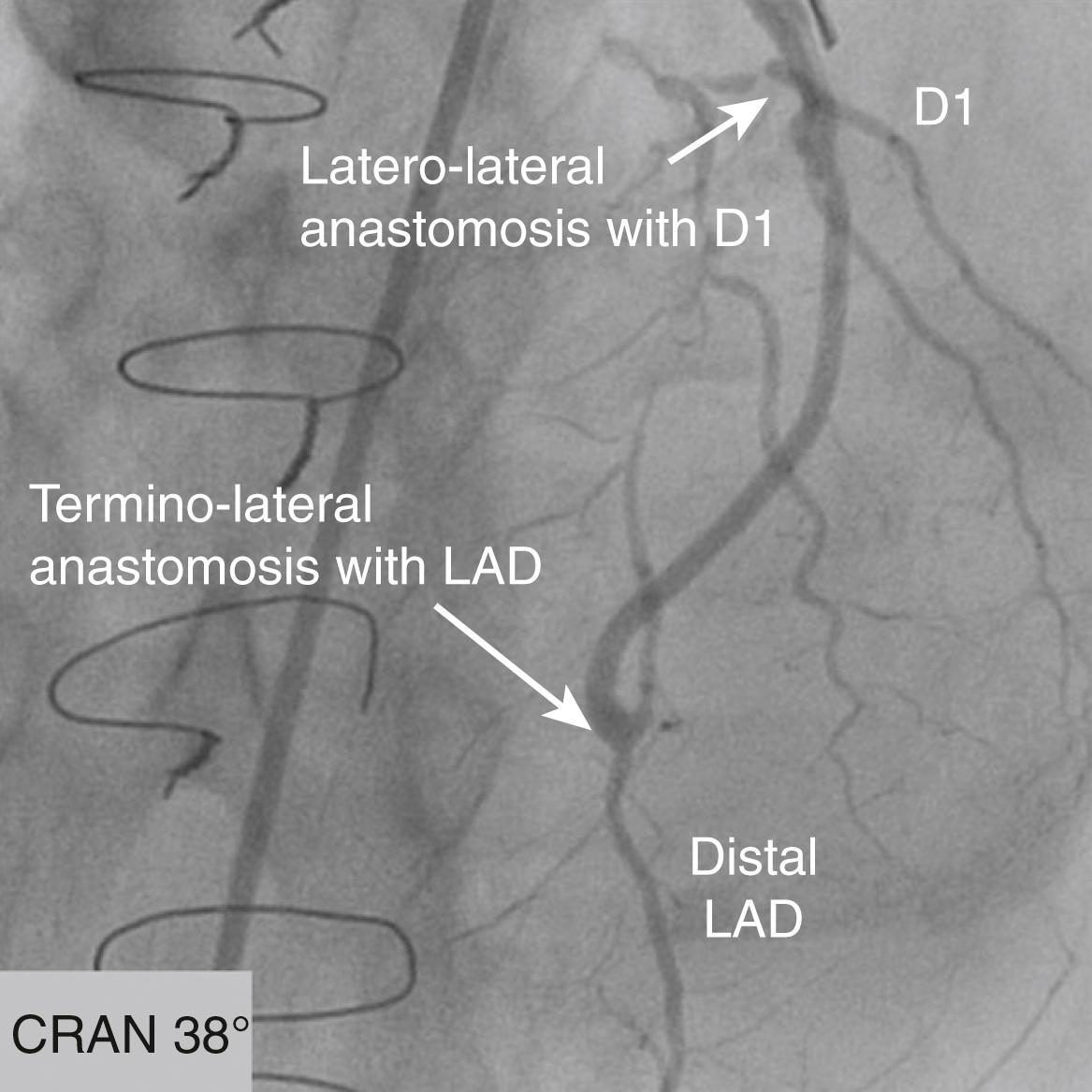FIGURE 21.6, Sequential saphenous vein graft to the first diagonal branch ( D1 ) and left anterior descending artery ( LAD ) with latero-lateral anastomosis to D1 and termino-lateral anastomosis to the distal LAD. CRAN, Cranial.