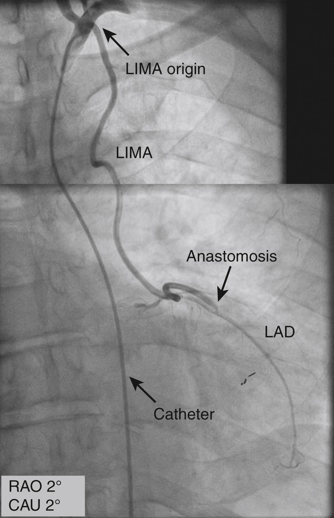 FIGURE 21.7, Arterial graft of left internal mammary artery ( LIMA ) to the left anterior descending artery ( LAD ). RAO, Right anterior oblique; CAU, caudal.