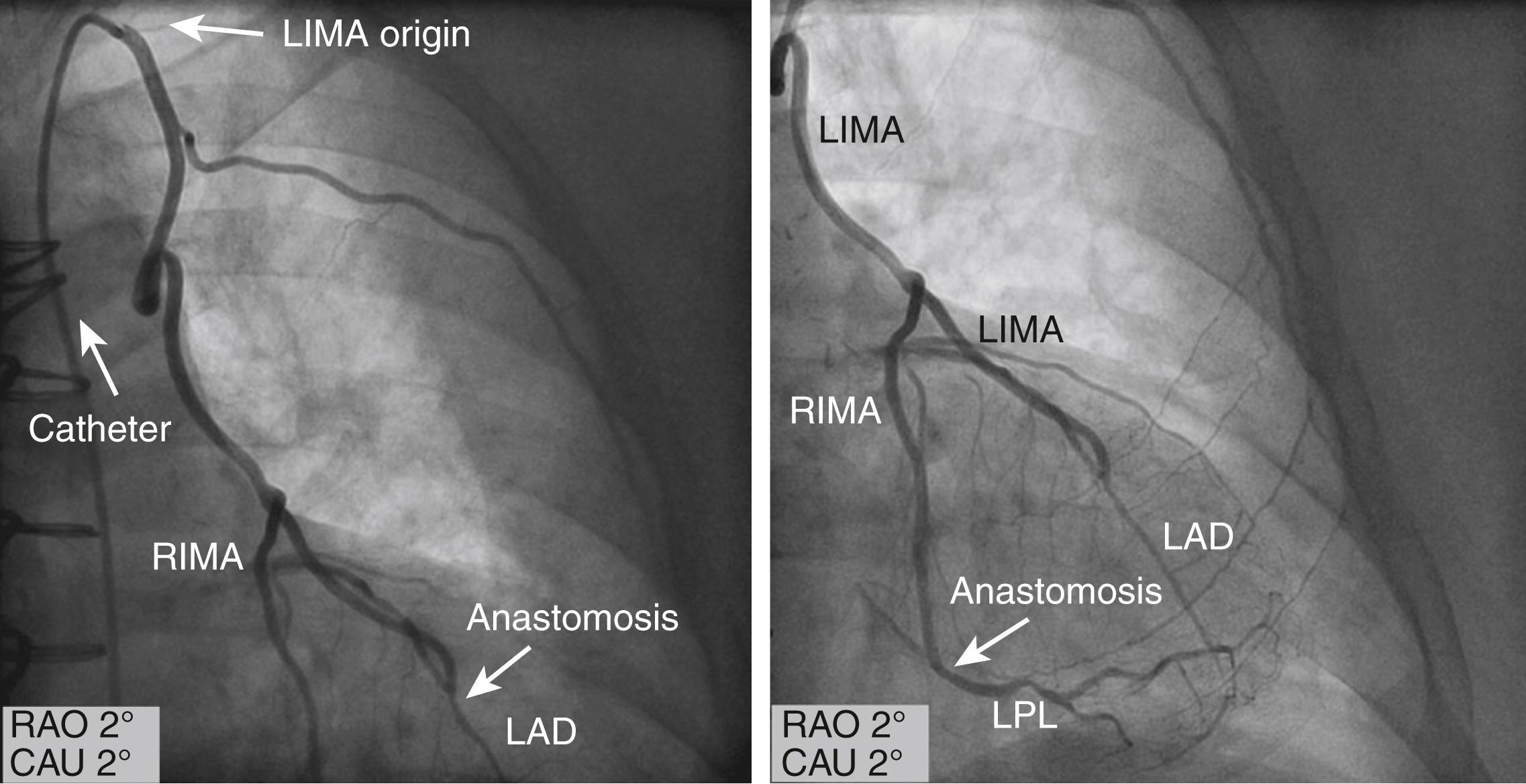 EFIGURE 21.3, Y graft of the left internal mammary artery ( LIMA ) to the left anterior descending artery ( LAD ) and the free right internal mammary artery graft ( RIMA ) to the left posterolateral branch ( LPL ). CAU, Caudal; RAO, right anterior oblique.