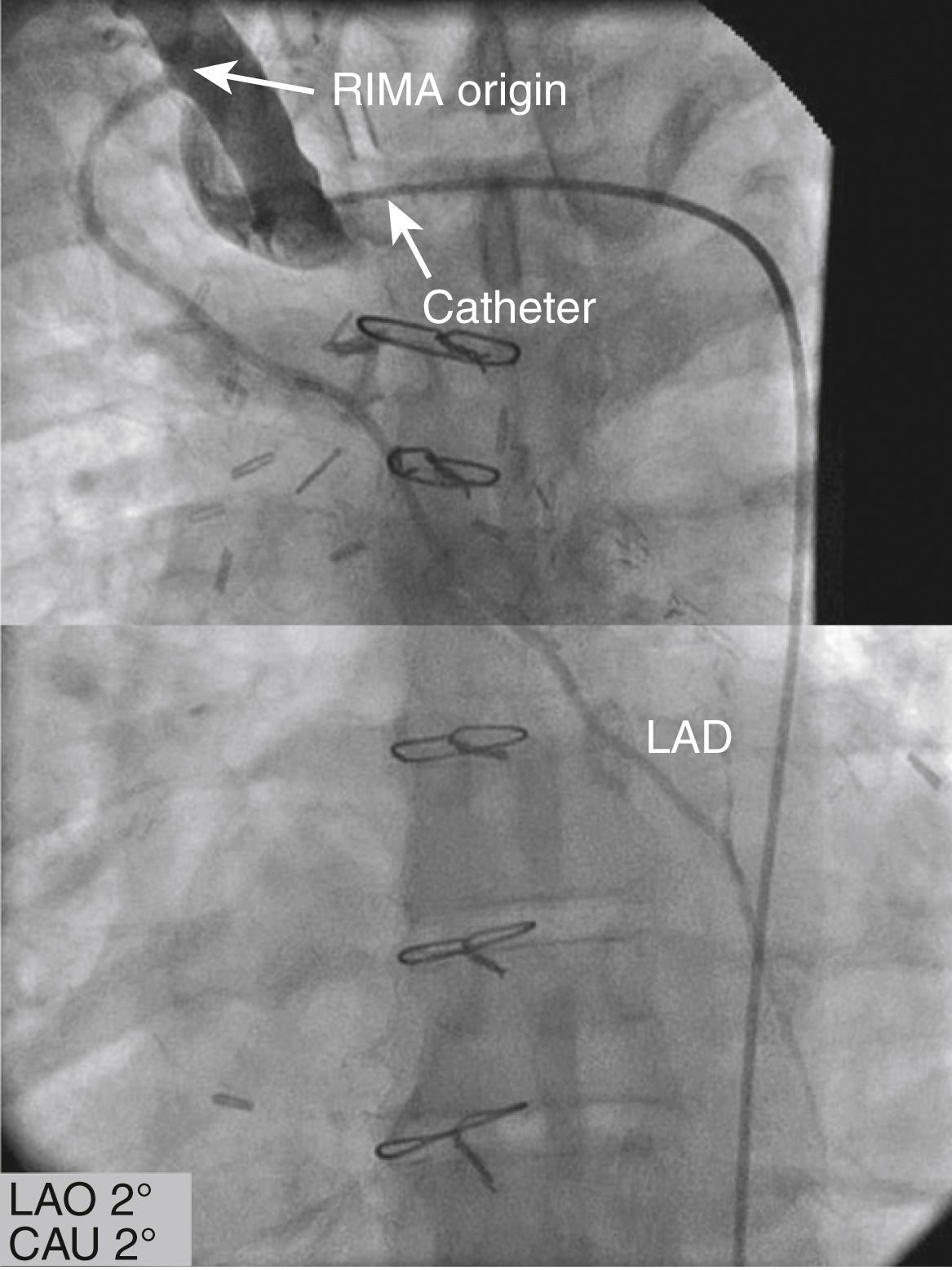 EFIGURE 21.4, Nonselective cannulation of the right internal mammary artery ( RIMA ) anastomosed to the left anterior descending artery ( LAD ). CAU, Caudal; LAO, left anterior oblique.