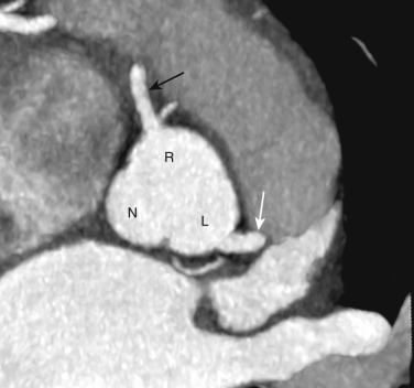 FIG 58-1, Normal coronary ostial anatomy. Transverse image through the aortic sinus from a coronary CTA shows the left (L), right (R), and noncoronary (N) sinuses. The left main coronary artery (white arrow) and right coronary artery (black arrow) arise normally from the left and right coronary sinuses, respectively.