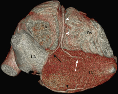 FIG 58-11, Distal right coronary artery (RCA) anatomy. Volume-rendered image of the inferior surface of the heart from a coronary CTA shows the distal RCA (white arrowheads) coursing in the inferior groove between the right atrium (RA) and right ventricle (RV). The RCA bifurcates into the posterior descending artery (PDA, white arrow ), which courses in the inferior interventricular sulcus or groove, and the posterior ventricular branch (black arrow), which supplies the inferior aspect of the left ventricular base. A large acute marginal branch (black arrowhead) from the LCx supplies the inferolateral aspect of the left ventricle (LV), which is anterior to the left atrium (LA).