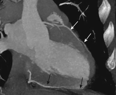 FIG 58-12, Variable size of the posterior descending coronary artery (PDA). Two-chamber view from a coronary CTA shows a large PDA (black arrows) extending to the left ventricular apex. The LAD (white arrows) is a smaller vessel that ends proximal to the apex.