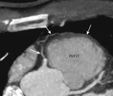 FIG 58-13, Anatomy of the conus artery. Axial oblique image from a coronary CTA shows the conus branch (white arrows), which is usually the first vessel to arise from the right coronary artery unless it arises directly from the right aortic sinus. The vessel courses superiorly and anteriorly to supply the right ventricular outflow tract (RVOT).