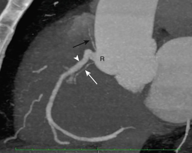 FIG 58-14, Multiple ostia. C-view through the right coronary artery (white arrowhead) from a coronary CTA shows that the conus branch (black arrow) and sinoatrial nodal branch (white arrow) both have separate ostia from the right sinus of Valsalva (R).