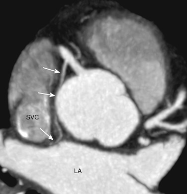 FIG 58-15, SA nodal branch anatomy. Axial oblique MIP image from a coronary CTA shows the SA branch (arrows) arising from the proximal right coronary artery (RCA) and coursing posteriorly to end between left atrium (LA) superior vena cava (SVC) just near its point of draining into the right atrium. The SA branch can arise from the LCx artery (see Fig. 58-2 ), both the RCA and LCx, or directly from the aorta.