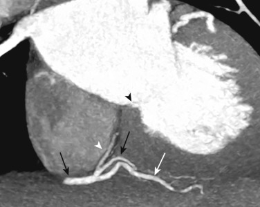 FIG 58-16, AV nodal branch anatomy. Coronal oblique MIP image from a coronary CTA shows the AV nodal branch (white arrowhead) arising from the distal right coronary artery (black arrows) as it makes a U-shaped bend over the posterior descending coronary artery (PDA, white arrow ). The AV nodal branch extends superiorly toward the inferior mitral anulus (black arrow).