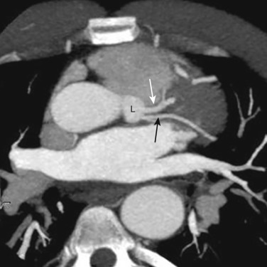 FIG 58-17, Absent left main coronary artery. Axial oblique image from a coronary CTA shows complete absence of the left main coronary artery. The LAD (white arrow) and LCx (black arrow) arise directly from the left sinus of Valsalva (L).