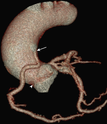 FIG 58-18, High origin of the RCA. Anterior volume-rendered image of the aorta and coronary ostia shows the RCA arising from the ascending aorta (white arrow), well above the sinotubular junction (white arrowhead). This is a benign anomaly.