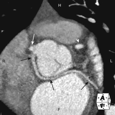 FIG 58-19, Retroaortic course. Coronal oblique image from a coronary CTA through the aortic root shows the LCx (black arrows) arising from the right coronary cusp and coursing posteriorly between the aortic root and atria. The LCx has an independent ostia from the RCA (white arrow) . The LAD (white arrowhead) originates from the left coronary sinus. This is a benign anomaly.
