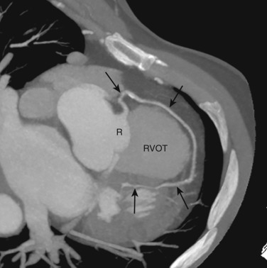FIG 58-20, Prepulmonic course. Axial oblique image from a coronary CTA shows LAD (black arrows) arising from the right sinus of Valsalva (R) and coursing anteriorly around the right ventricular outflow tract (RVOT), consistent with a prepulmonic or precardiac course. This is a benign anomaly.