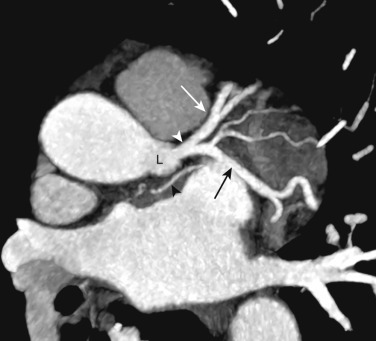 FIG 58-2, Normal left main anatomy. Double oblique image from a coronary CTA shows the left main coronary artery (white arrowhead) arises from the left sinus of Valsalva (L). The left main bifurcates into the LAD (white arrow) and LCx (black arrow). The sinoatrial nodal branch arises from the LCx in this patient (black arrowhead).