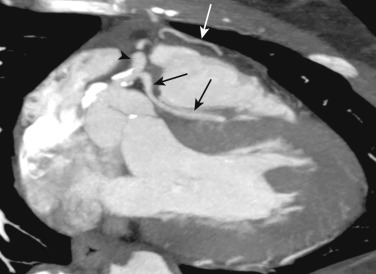 FIG 58-21, Septal course of the LAD. Sagittal oblique MIP image from a coronary CTA in a patient with a single right coronary artery (arrowhead) shows the LAD coursing inferiorly and medially (black arrows) before diving into the interventricular septum. This benign course needs to be delineated from the malignant interarterial course where the coronary artery crosses directly between the main pulmonary artery and aorta. The patient also had a prepulmonic LAD (white arrow) that supplied the anterior and anterolateral segments.