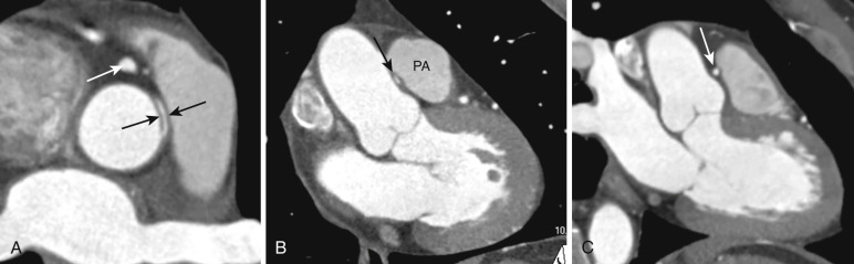 FIG 58-22, Incidental finding of an interarterial course of the right coronary artery (RCA) in a 56-year-old man. Axial oblique ( A ) and sagittal oblique ( B ) images from a coronary CTA show the RCA (black arrows), which arises above the left coronary sinus, coursing between the aorta and pulmonary artery (PA). The proximal vessel is surrounded by soft tissue density ( A ) and narrowed in width, with an increased height-to-width ratio. These findings are secondary to the intramural portion of the artery where it courses in the wall of the aorta. A few centimeters distal to the ostium, the RCA is normal in size (white arrow). C, Sagittal oblique image a few centimeters distal to the RCA ostium show a normal rounded appearance to the RCA (white arrow) where the height and width are equal.