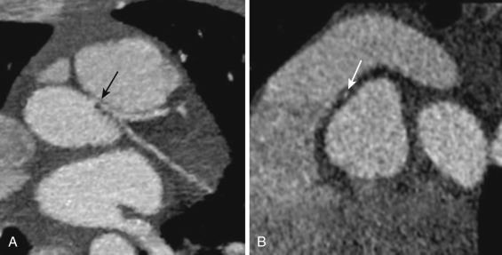 FIG 58-23, Interarterial course of the left main coronary artery in a 13-year-old girl who presented to the emergency department in ventricular fibrillation. The girl had been playing lacrosse before her cardiac arrest. A, Axial oblique image from a coronary CTA shows the left main (black arrow), which arises above the right coronary sinus, coursing between the aorta and pulmonary artery. B, Sagittal oblique image through the proximal left main shows severe narrowing of the vessel (white arrow) as it courses between the aorta and pulmonary artery. A 7-mm intramural course of the proximal left main was confirmed at surgery when the patient underwent an unroofing procedure.